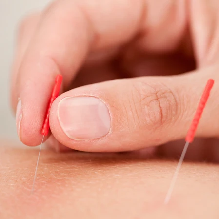 Dry needles being placed in to the skin.